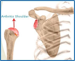 Arthritis Shoulder