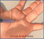 Local Anesthesia