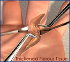 Thickened Fibrous Tissue