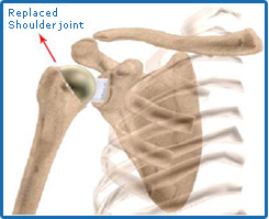 Replaced Joint Shoulder